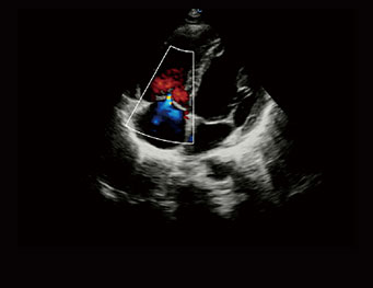 三尖瓣反流，CW 模式