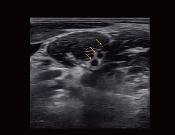 臂丛神经，B 模式