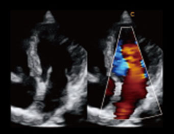 主动脉反流，BBC 模式