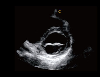 二尖瓣短轴，自由M模式