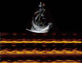 二尖瓣短轴，B 模式
