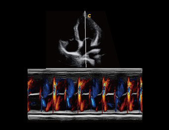 心尖四腔心，彩色M模式