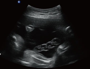 胎儿脐带，B 模式