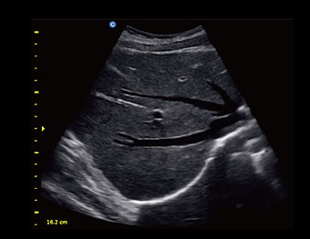肝脏，B 模式