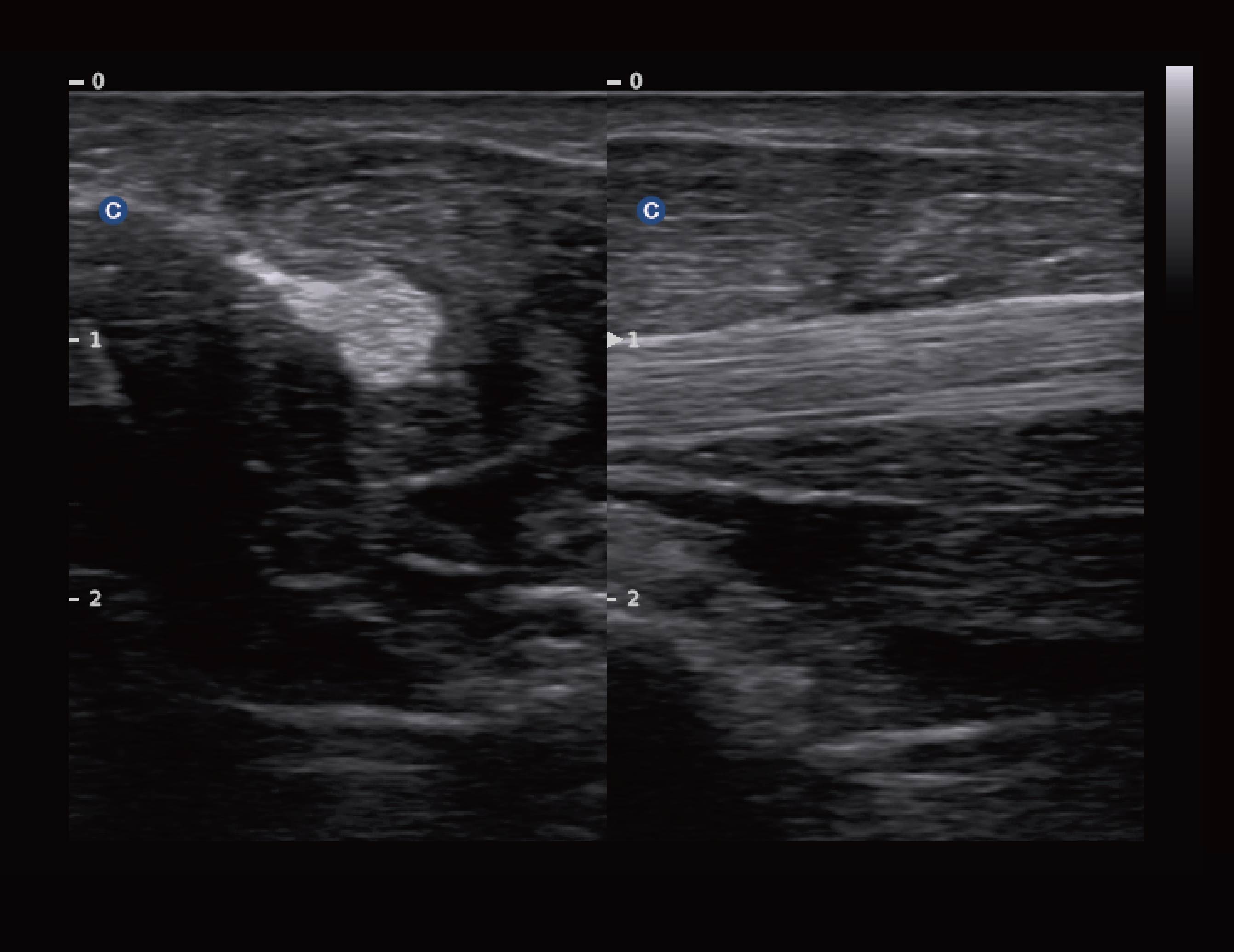 拇长屈肌腱，B模式