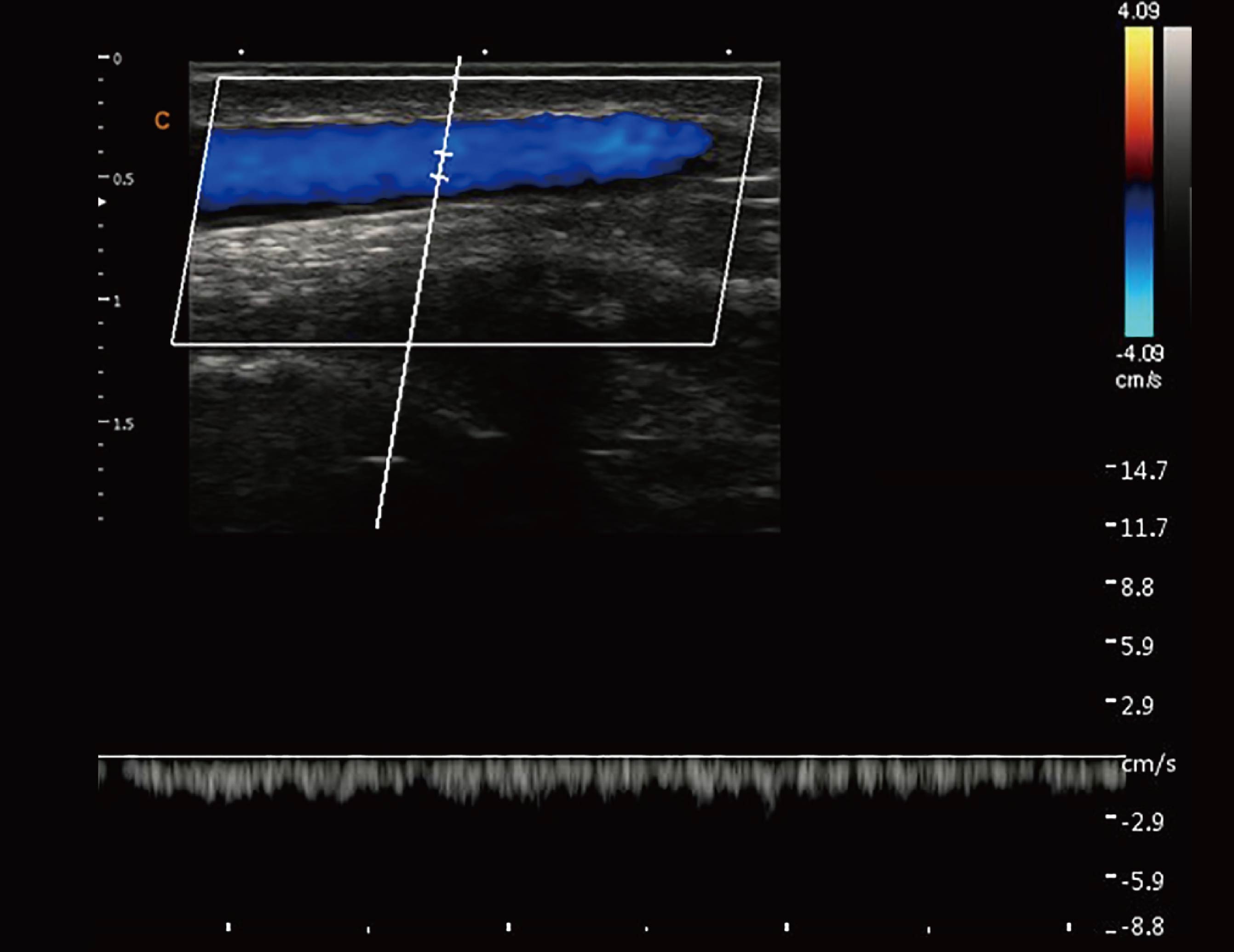 贵要静脉，PW模式