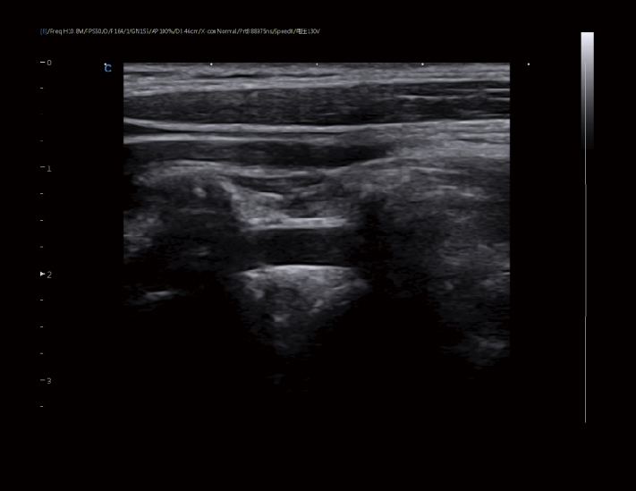 椎动脉，B模式