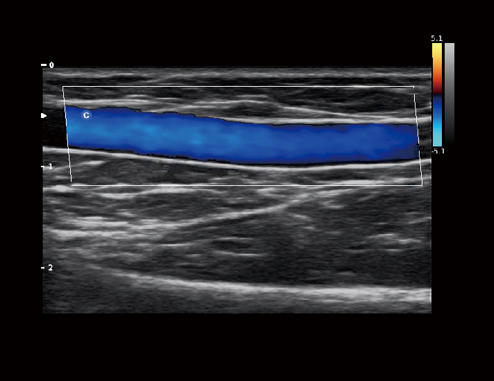 血管，C模式