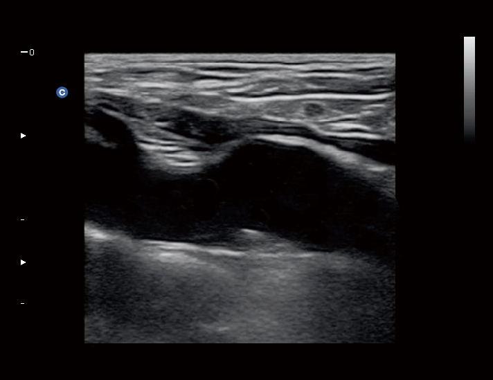 血管，B 模式