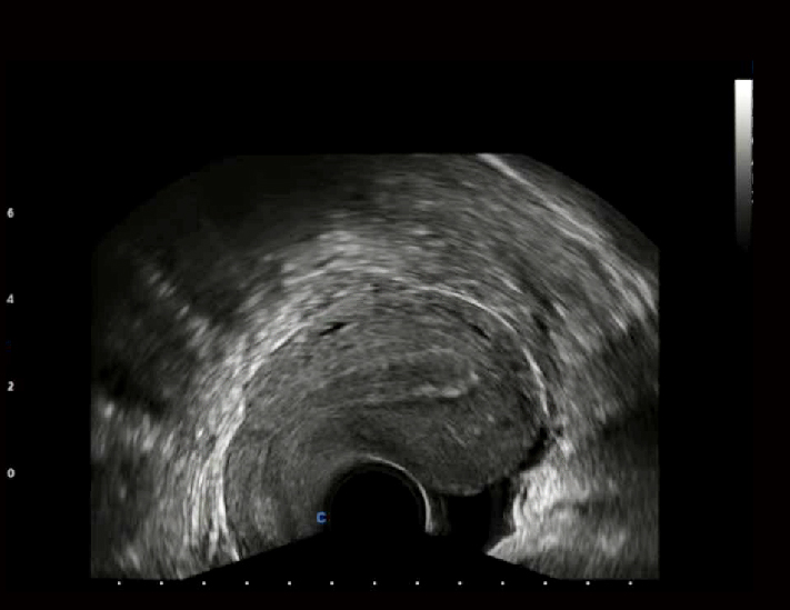 子宫阴式，B模式