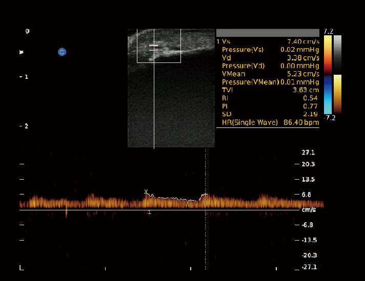 浅表血管，PW模式